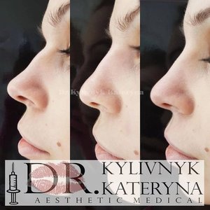 инъекционная коррекция носа