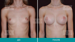 увеличение груди