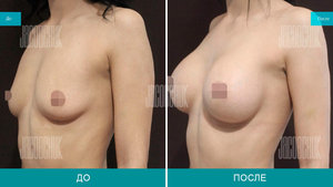 увеличение груди