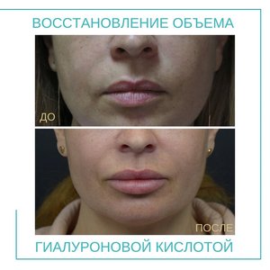 Иньекции, увеличение губ