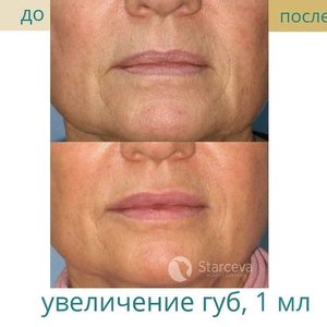 Иньекции, увеличение губ