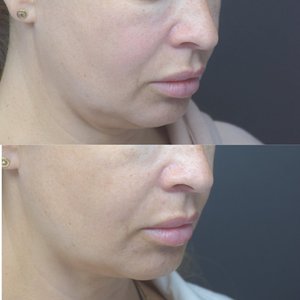 Ботулотоксин в мимимеские мышцы, наполнение щек, скул.  Фото 2