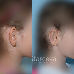 Операция - коррекция оттопыренных ушей. Фото 2
